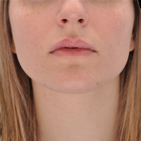 Botox Dermal Fillers Case 3444 Dr Ali Abtahi Amor Propio Botox Dermal Fillers Case 3444 Dr Ali Abtahi Amor Propio