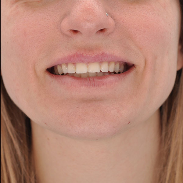 Botox Dermal Fillers Case 3444 Dr Ali Abtahi Amor Propio Botox Dermal Fillers Case 3444 Dr Ali Abtahi Amor Propio