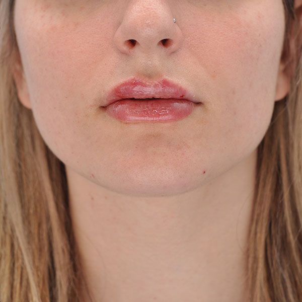 Botox Dermal Fillers Case 3444 Dr Ali Abtahi Amor Propio Botox Dermal Fillers Case 3444 Dr Ali Abtahi Amor Propio